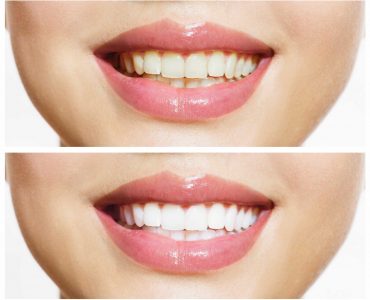 Teeth Whitening Gold Coast