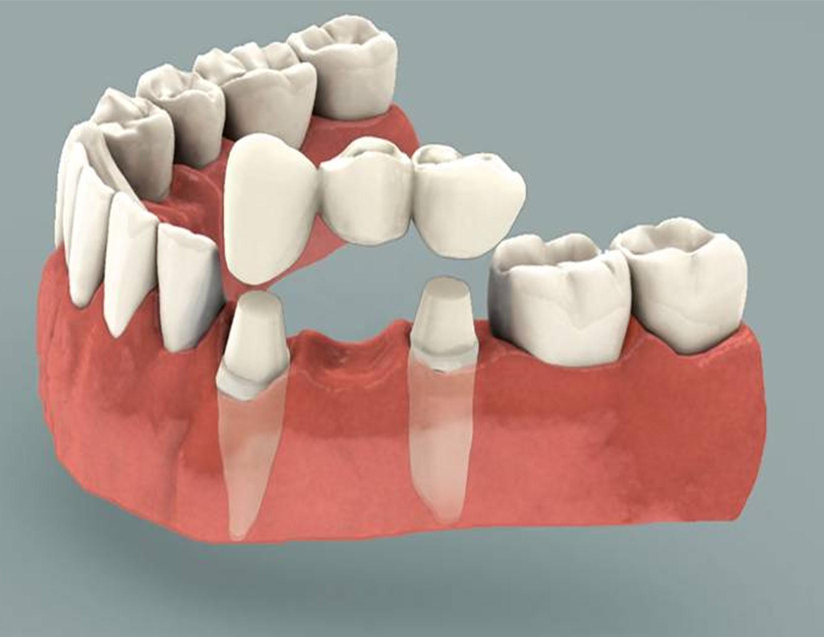 Dental Crowns Newcastle