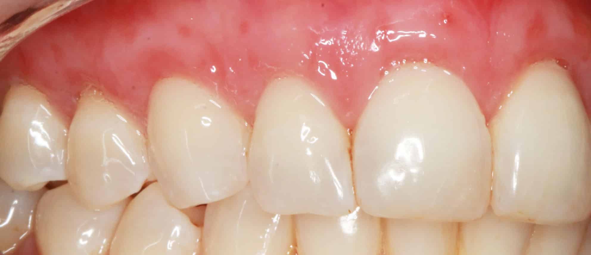 Teeth Veneers Gold Coast Best Gold Coast Dentist 2021