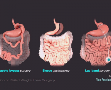 Gastric Bypass Sleeve