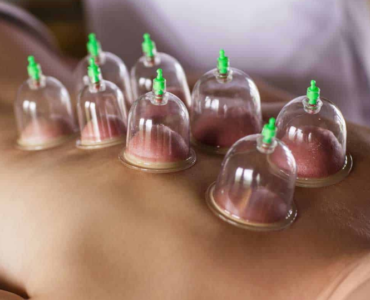 Acupuncture cupping