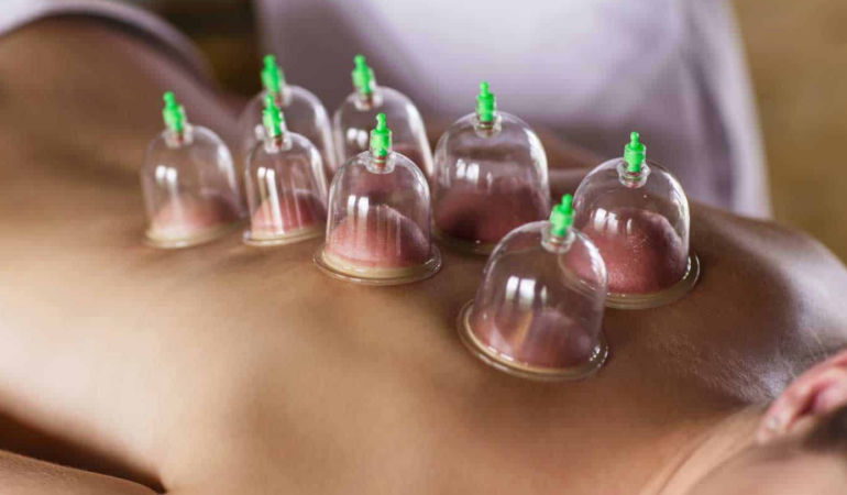 Acupuncture cupping