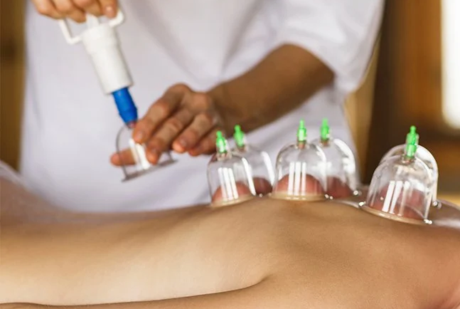 Acupuncture cupping