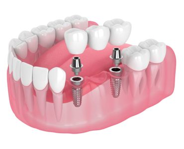 Dental implants in Newcastle