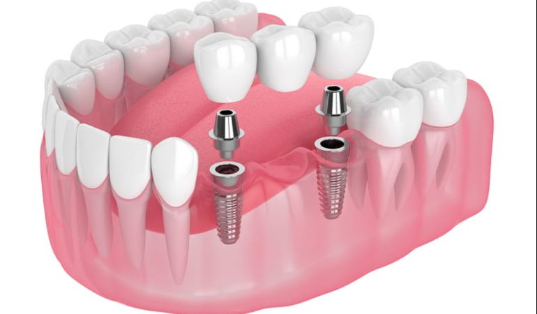 Dental implants in Newcastle